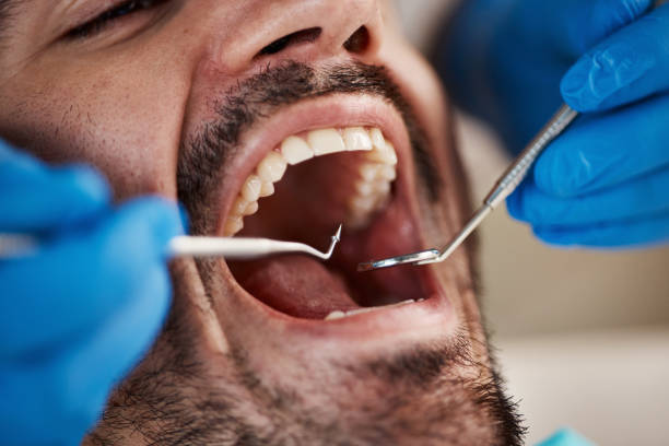 Best Emergency Tooth Extraction in St Bonifacius, MN